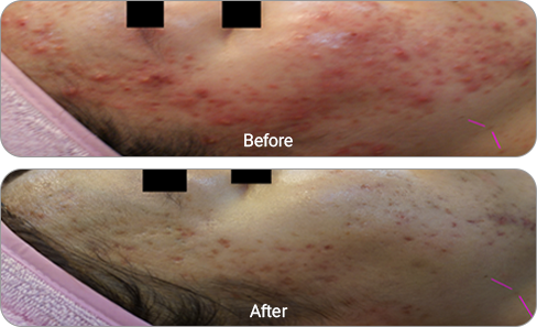 2회 4주간격 전후사진