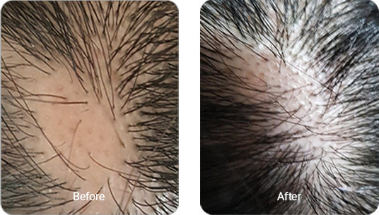 원형 탈모 엑소좀 테스트 3개월 경과